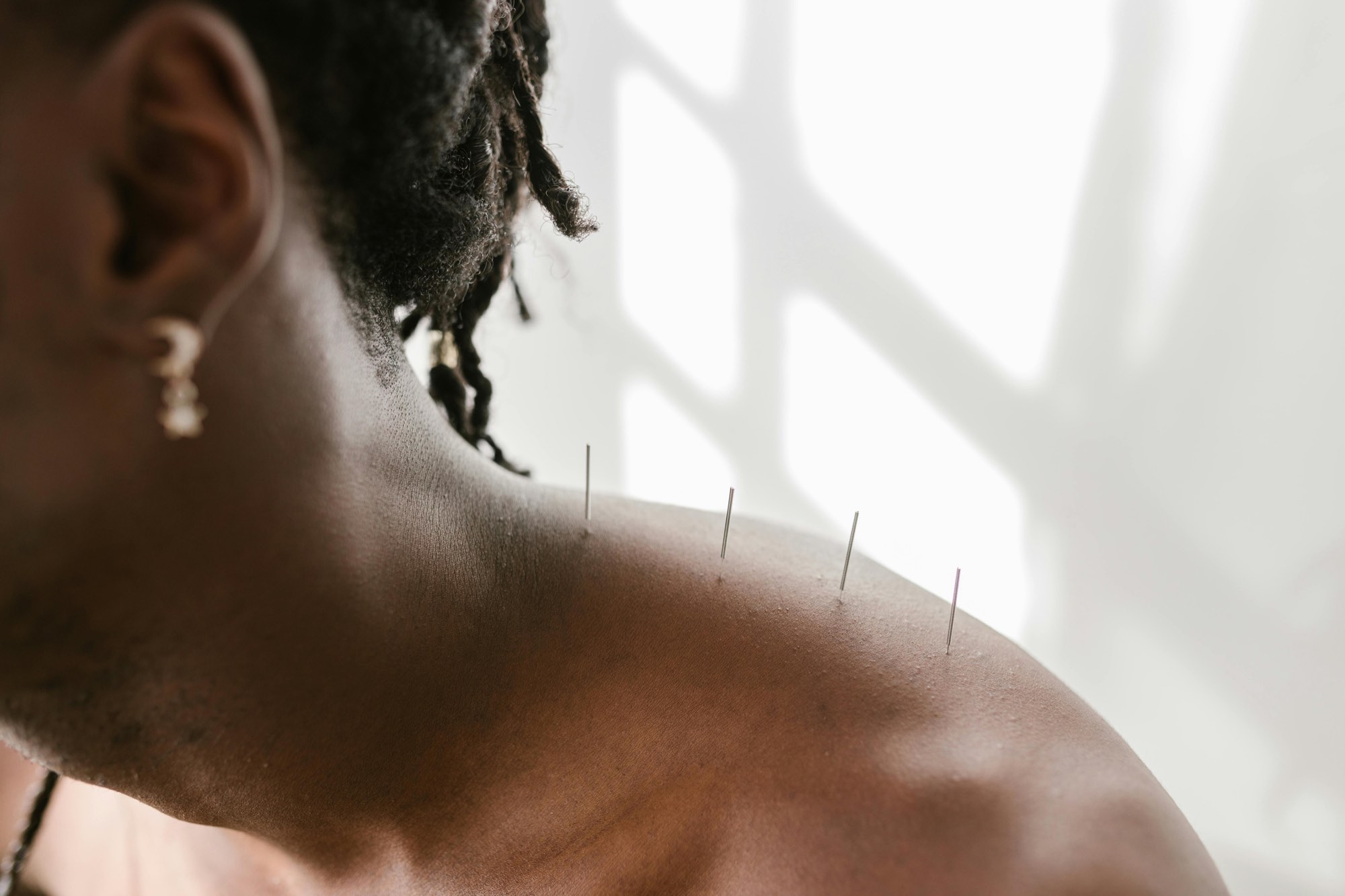 Acupuncture needles along a patient&rsquo;s shoulder